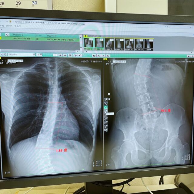 文部科学省の集団行動指導の手引きの『体育座り』制度を廃止し、簡易的なイスの導入や正しい姿勢で座れる環境・教育を目的としています。
また、側弯症の早期発見の『側弯症検診機器』を全国の小中高に導入させ、先生・生徒・ご家族の方々に側弯症を知ってもらう事も同時に活動しています。

まずはHPの作成、SNSの拡散、月1回の側弯症をお持ちの方と患者会(予定)、賛同してくださる方々を集めNPO法人の立ち上げ、既に体育座りの廃止を考えている全国の小中高との対談、側弯症を研究や治療をしている先生との対談、身体やイスを研究している先生監修のイス制作、教育委員会との対談、そして文部科学省の『制度改定』をさせる為に常にいろんな方からの情報やアドバイスをもらい、高い意識と強い意志で頑張ります。

#体育座り廃止 #NPO法人 #立ち上げ #協力してくる人募集中 
#学校 #日本を変える #側弯症 #持病 #教育 #体育座り #脊柱 #脊柱側弯症 #整形外科 #リハビリ #側弯 #japan #tokyo #日本 #東京 #me #follow #followme
