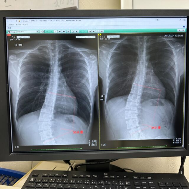 久しぶりにレントゲンを撮りました🩻
今回は違う先生に診てもらいましたが、1年半前と比べると0.6度進行してました…
先生は測り方の誤差が多少あるので問題ないとは言っていたものの、進行してるのは事実です。
これが積み重なって何十年単位となってくると変わってくるのは間違いないので、正直言うと結構適当な先生は多いと僕は感じています。
なので、どの先生に診てもらうか長期的目線で考え、真摯に対応をして下さる先生を選んだ方が良いかと常に思っています🏥

#体育座り廃止へ #NPO法人 #立ち上げ #協力してくる人募集中 
#学校 #日本を変える #側弯症 #持病 #教育 #体育座り #脊柱 #脊柱側弯症 #整形外科 #リハビリ #側弯 #japan #tokyo #日本 #東京 #me #follow #followme